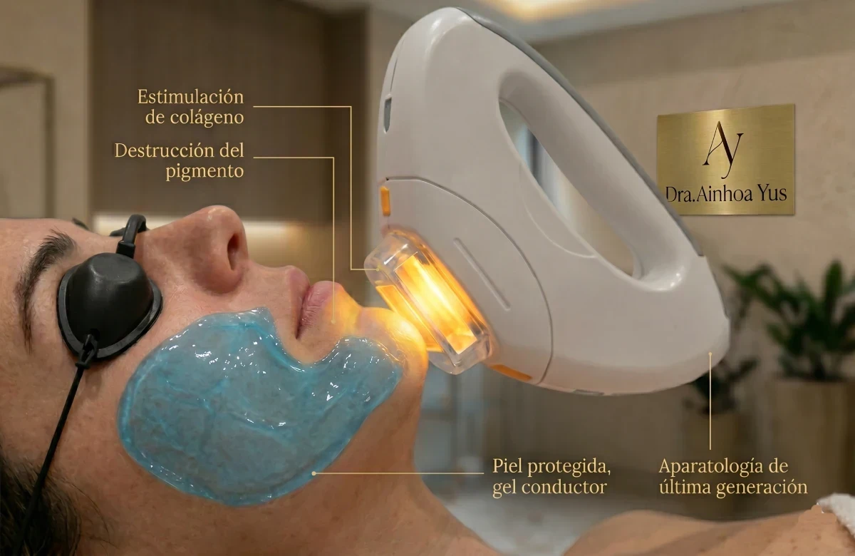 Infografía médica del cabezal IPL aplicando luz pulsada sobre la piel con gel conductor para la destrucción del pigmento y estimulación de colágeno.