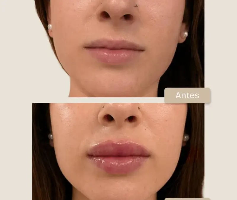 Armonización de perfil y aumento de volumen labial