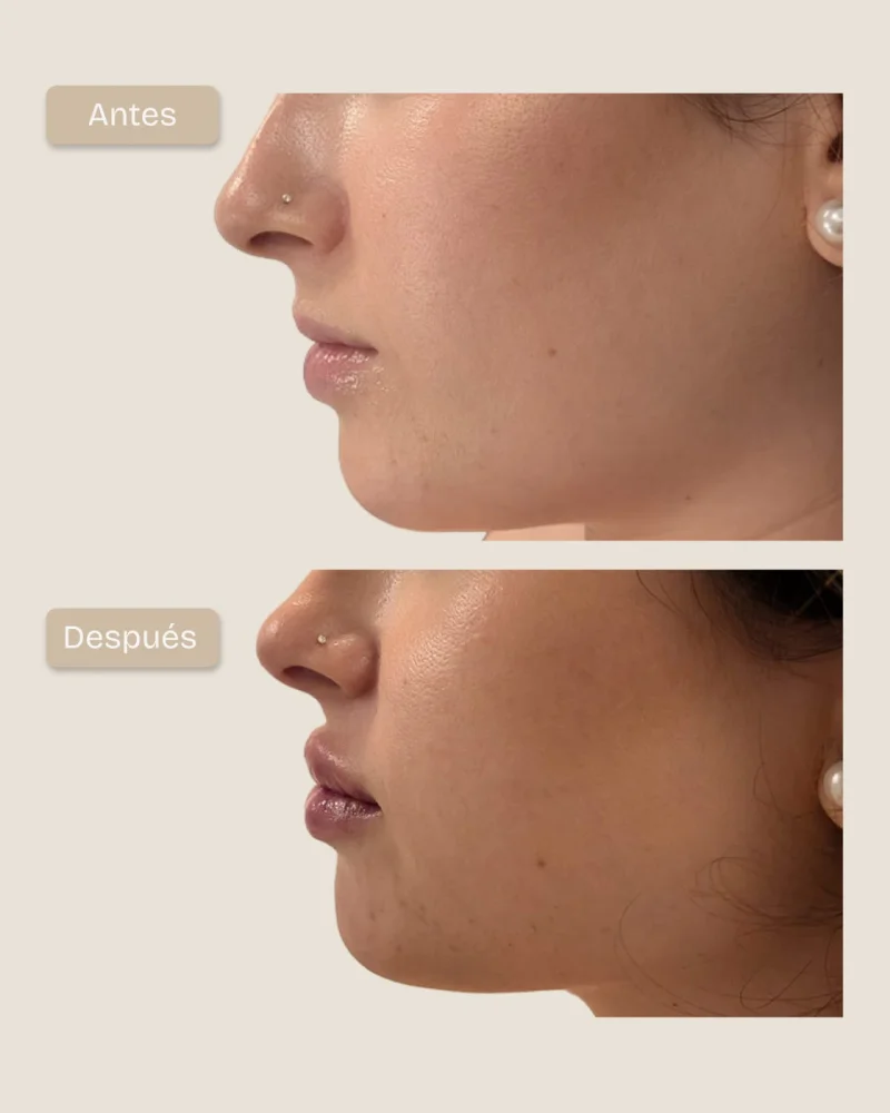 Antes y despues de armonizacion del perfil y aumento labial con acido hialuronico vista de perfil