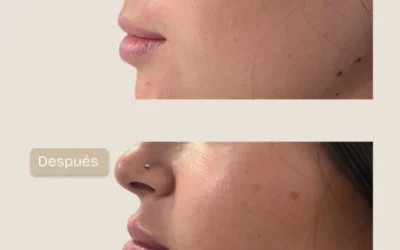 Aumento de volumen y perfilado de labios para lograr proporción y equilibrio