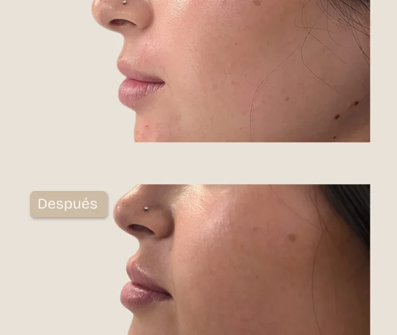 Aumento de volumen y perfilado de labios para lograr proporción y equilibrio