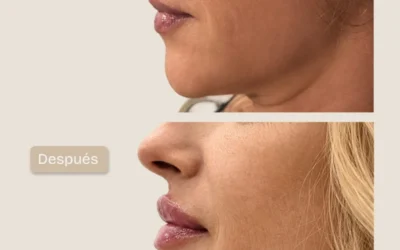 Hidratación y perfilado de labios con ácido hialurónico