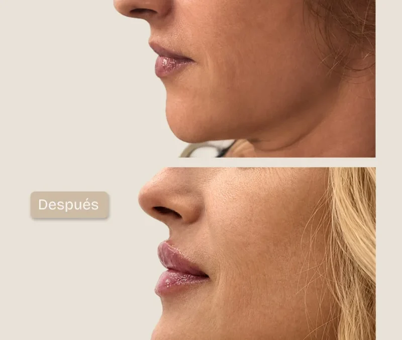 Hidratación y perfilado de labios con ácido hialurónico