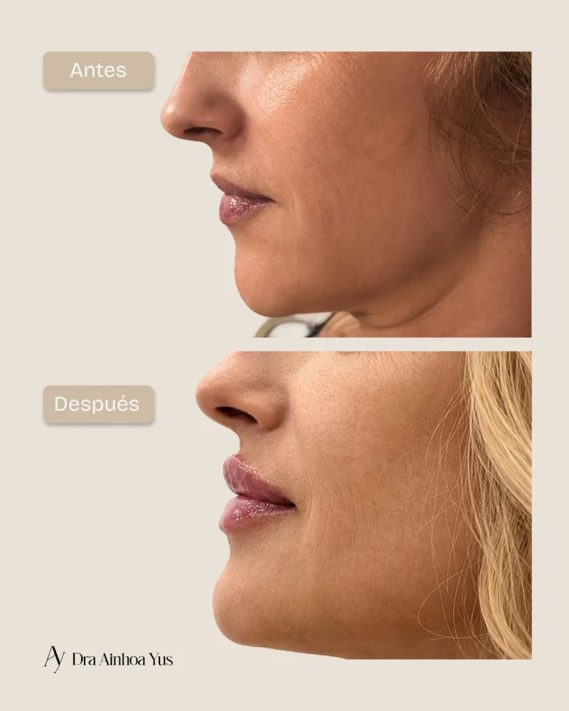 Antes y despues de hidratacion y perfilado de labios con acido hialuronico en vista de perfil