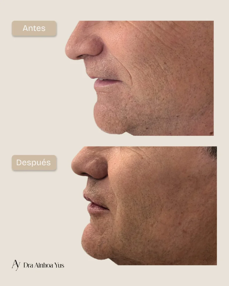 Antes y despues de recuperacion de volumen y proyeccion labial en hombre vista de perfil