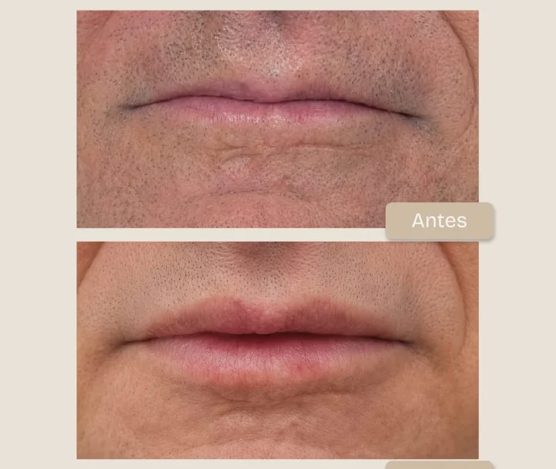 Recuperación de volumen y rejuvenecimiento labial masculino