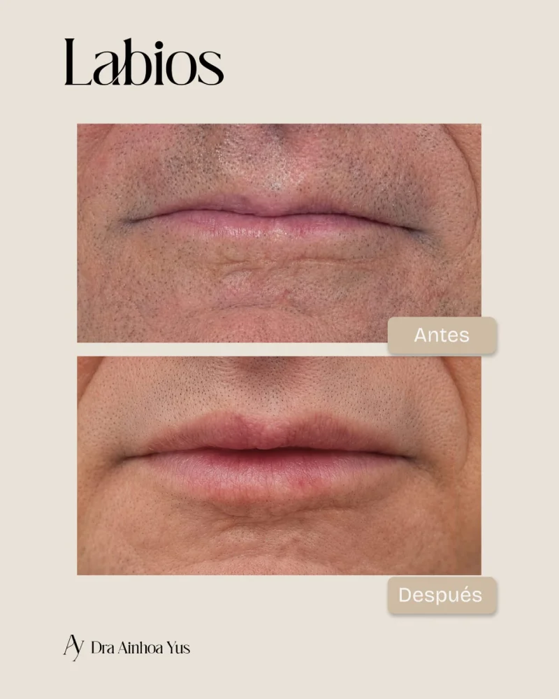 Antes y despues de rejuvenecimiento labial masculino con acido hialuronico vista frontal