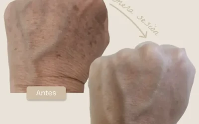 Rejuvenecimiento de manos con Luz Pulsada Intensa (IPL)