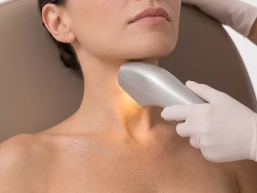 Tratamientos de Luz Pulsada Intensa (IPL): Casos y Resultados