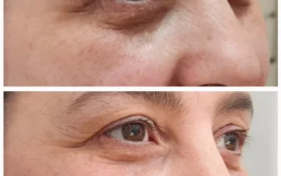 Caso Real: Relleno de Ojeras Hundidas y Rejuvenecimiento de la Mirada con Ácido Hialurónico