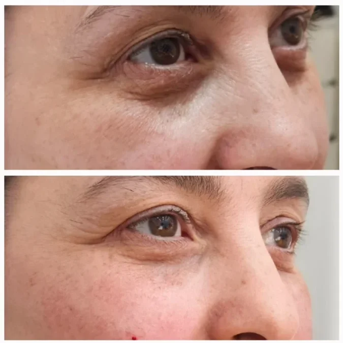 Caso Real: Relleno de Ojeras Hundidas y Rejuvenecimiento de la Mirada con Ácido Hialurónico