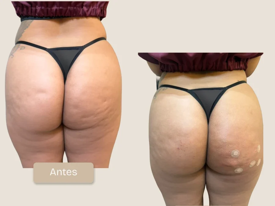 Caso Real: Remodelación de la Curva Lateral de Caderas y Glúteos con Lanluma X