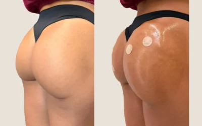 Caso Real: Corrección de Hip Dips y Redondeo Glúteo con Lanluma X