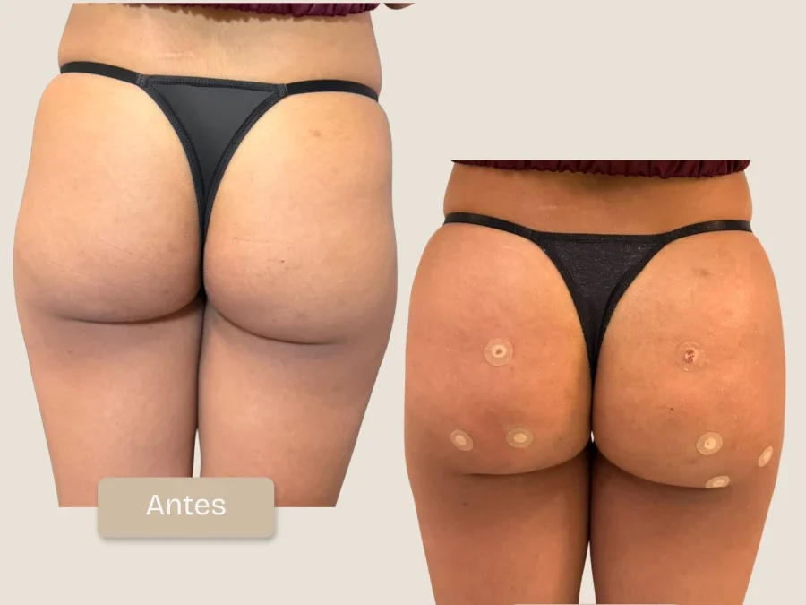 Caso Real: Armonización Glútea, Simetría y Volumen Natural con Lanluma X