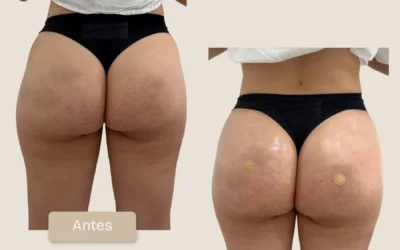 Caso Real: Remodelación Glútea Global, Redondeo y Firmeza con Lanluma X