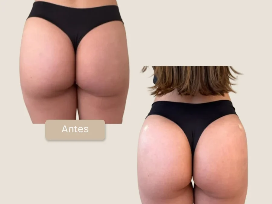 Caso Real: Definición, Elevación del Polo Superior y Volumen Natural con Lanluma X