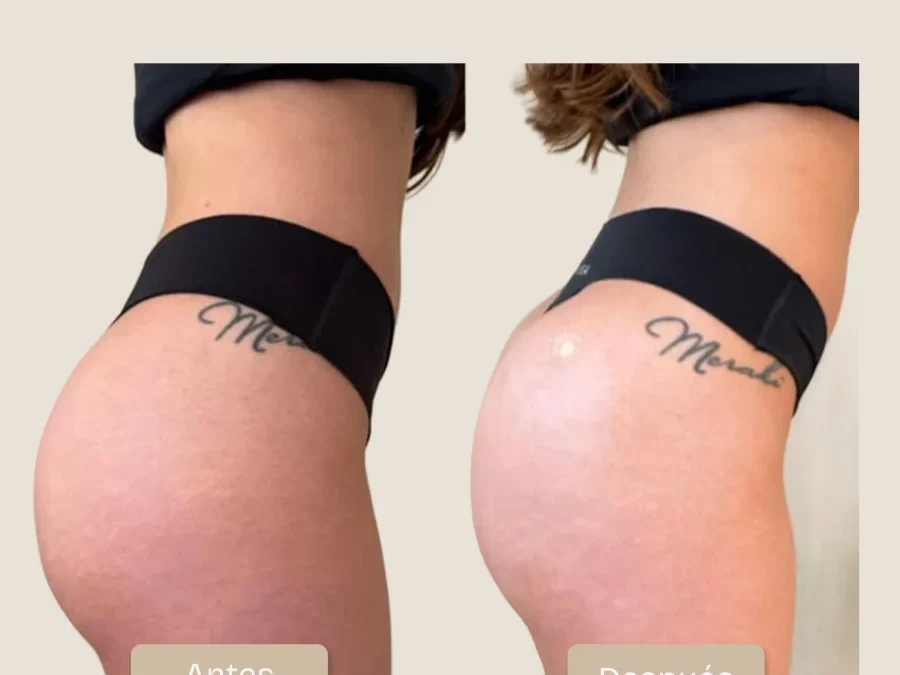 Caso Real: Efecto Push-Up, Proyección de Perfil y Elevación Glútea con Lanluma X